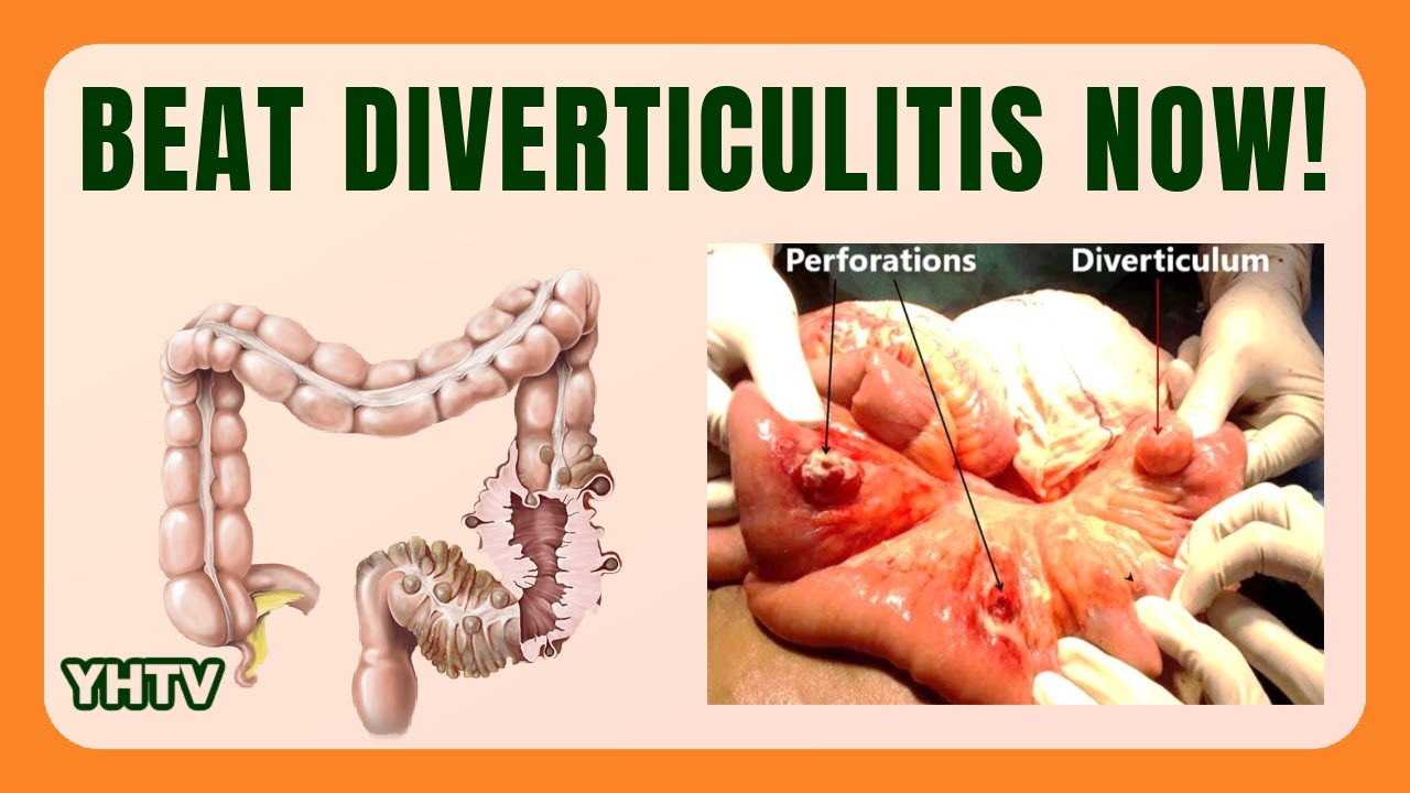 Diverticulitis Diet Best Foods, Tips & Meal Plans to Heal