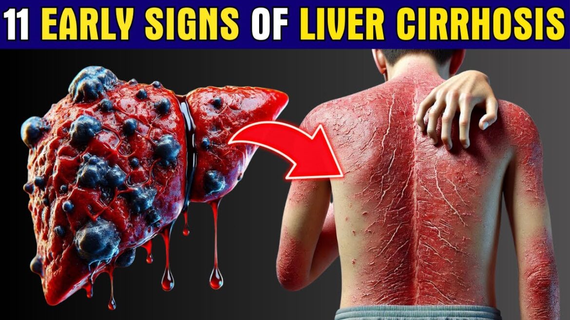 LIVER is DYING! 11 Early Warning Signs of Liver Cirrhosis You Can't Ignore | Healthy Care
