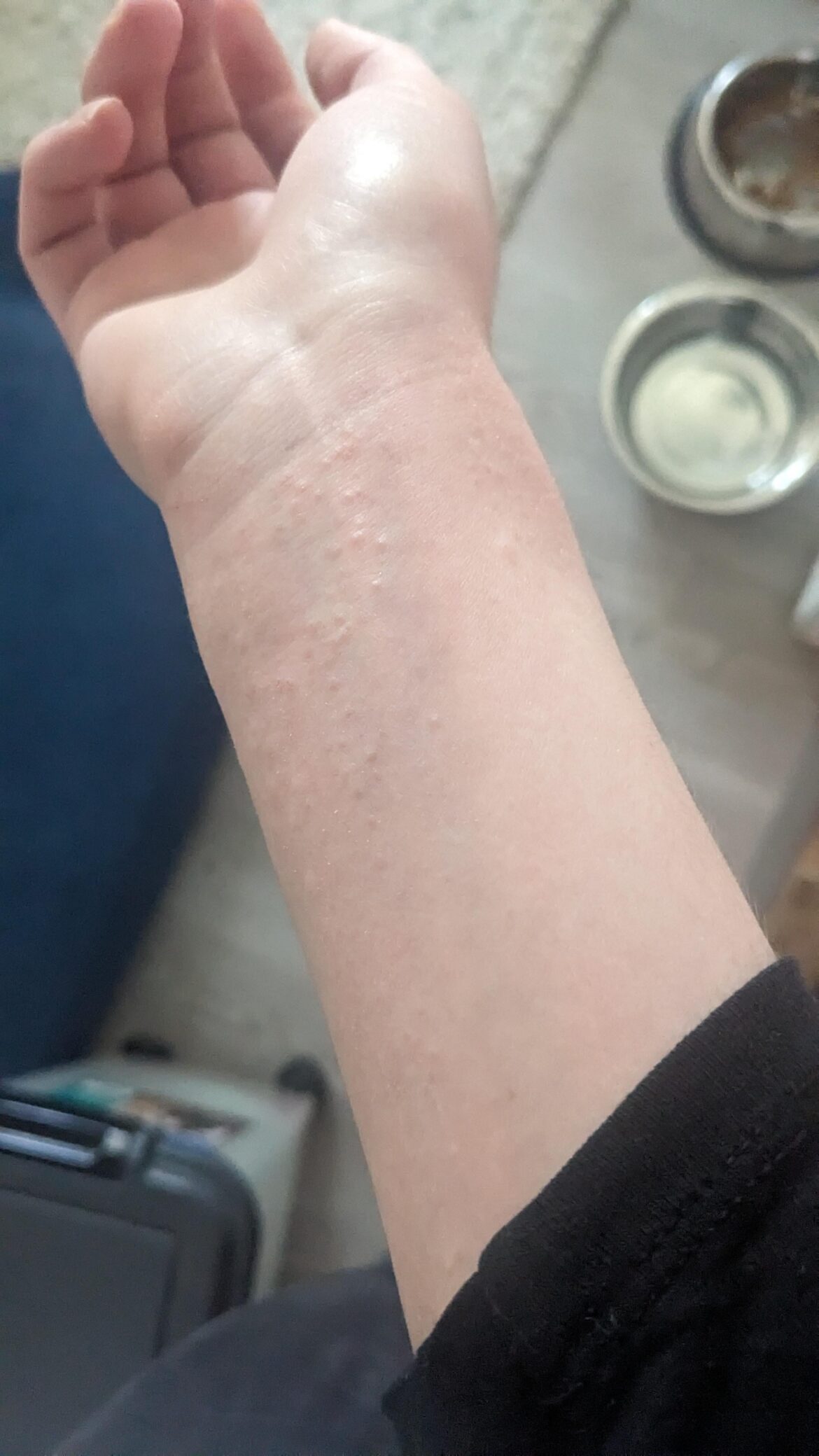 Using the heel of my palm to pound out pizza doughs all day. Could that be the cause of this? How do I stop it?