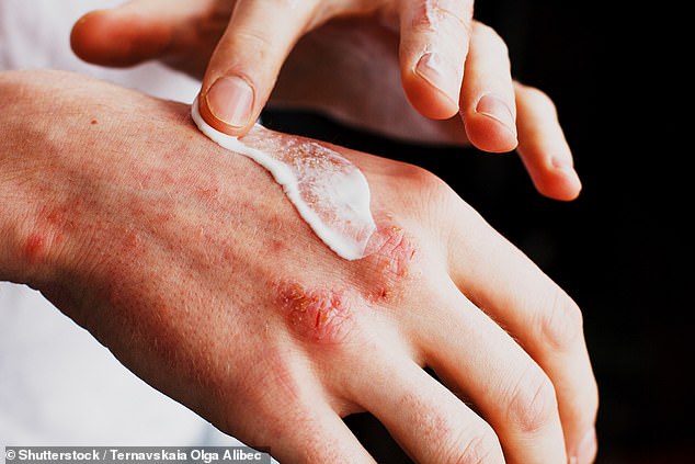 Psoriasis is a skin condition that causes flaky, scaly patches of skin to appear on the body, and about one in 50 Brits have it