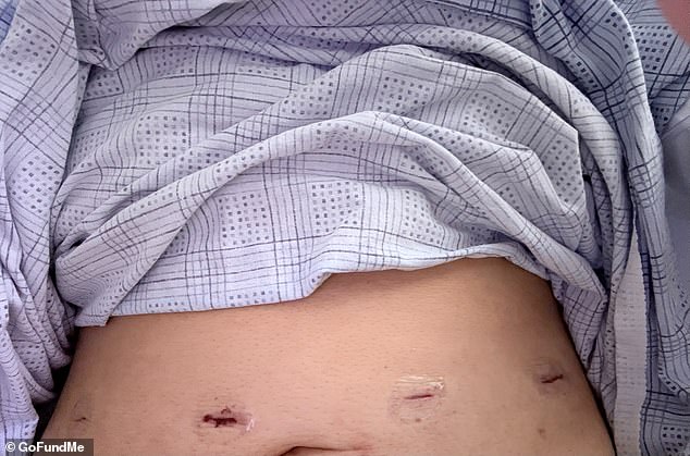 Ms Ramirez had to have her gallbladder removed as a result of severe damage to her liver, which processes digestive fluids