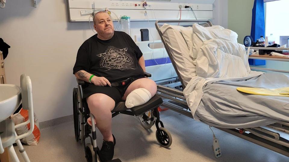 A man is sitting in a hospital room in a wheelchair.  His left leg has been amputated below the knee and has a bandage over the end.