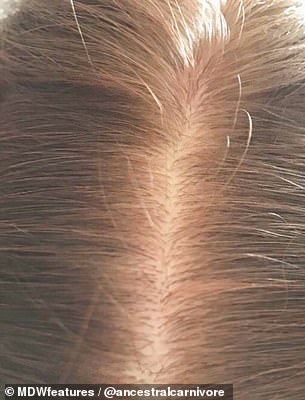 Pictured is Natalie's scalp now