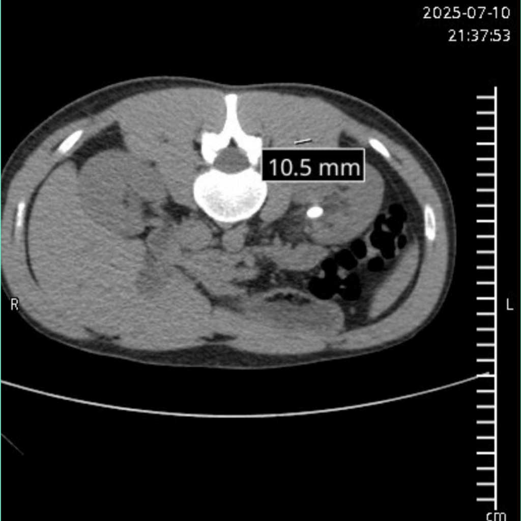 Be careful if you get chronic kidney stones
