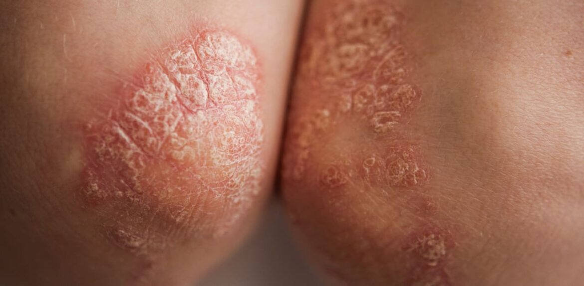 Mediterranean Diet Cut Psoriasis Severity Over 16 Weeks