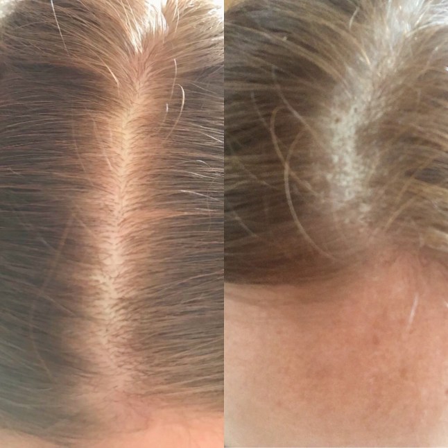 BUDAPEST, HUNGARY: Natalie's scalp eczema (right) since when she was vegan and how it has healed since going carnivore (left). THIS WOMAN claims a vegan diet left her barely able to hold a GLASS OF WATER - but since swapping plants for ANIMAL BRAINS she?s never felt better. Nutrition consultant, Natalie Daniels (38) who lives in Budapest, Hungary, grew up following a modern Mediterranean diet which consisted of pasta, bread, rice, potatoes, vegetables, lean meat and olive oil. In her late teens and early twenties, Natalie started to notice a connection between the foods she ate and the way they made her feel. At the time she was also practising yoga and linked it with a plant-based diet for good health. She went pescatarian and over time she lost her period and her health started to decline. In 2009 Natalie decided to strip out fish, eggs and dairy from her diet and go vegan. She cooked her meals from scratch and took vitamins and other health supplements but instead of feeling better in herself, her appearance started to change, she lost muscle tone, became pale and had sunken eyes with dark circles. As well as this, Natalie was diagnosed with a thyroid condition, had constipation, was bloated, suffered from hair loss, scalp eczema, sensitive teeth, brain fog and developed joint pain so severe she struggled to hold a glass of water in her hands. Natalie followed a largely vegetarian diet for 12 years and was vegan for three, but in 2015 she decided to re-introduce animal products into her diet until in January 2018, she discovered the carnivore diet and adopted the Paleolithic ketogenic diet (PKD), a type of meat-only diet where she eats solely animal products at a 2:1 fat to protein ratio. She enjoys a wide range of animal products from liver, brain, ribeye steak, beef tartare, raw lamb, pork crackling, pork ribs and broths made from boiling animal offcuts including the head. In a year Natalie has gone from 5st 11lb to 6st 10lb and says all her previous health s