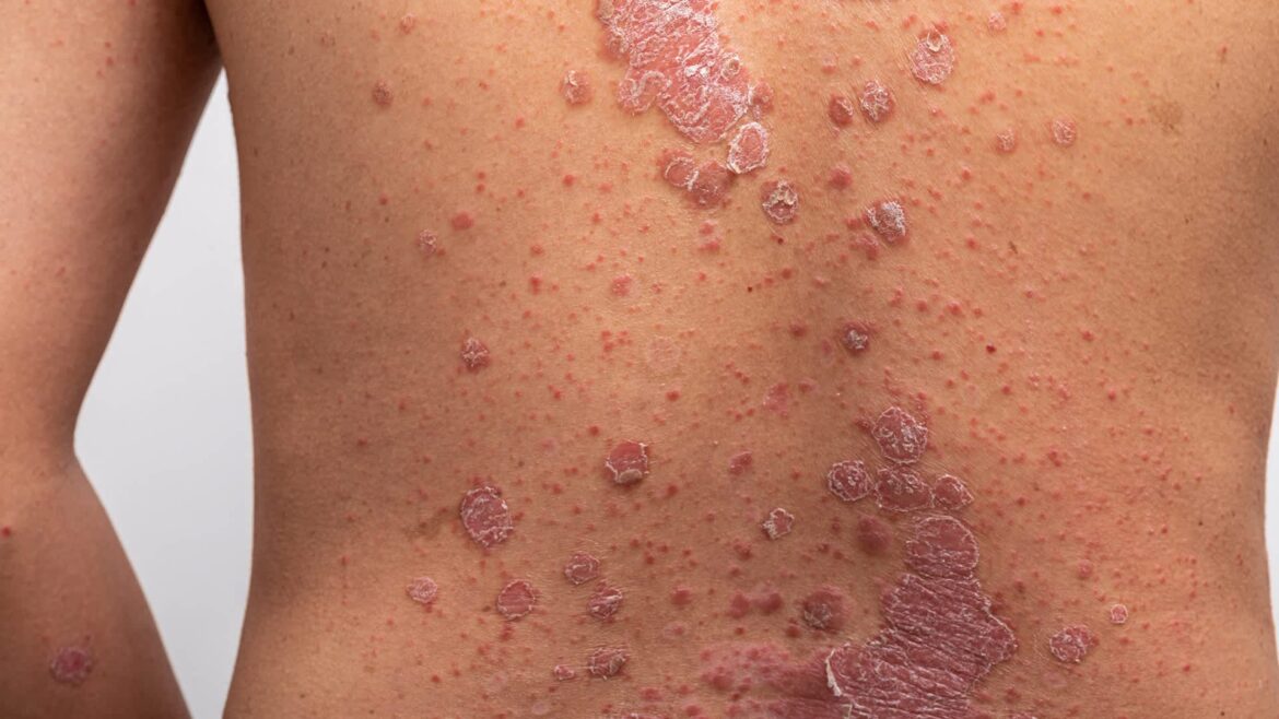 A new study has found that switching to a Mediterranean diet could significantly reduce psoriasis symptoms.