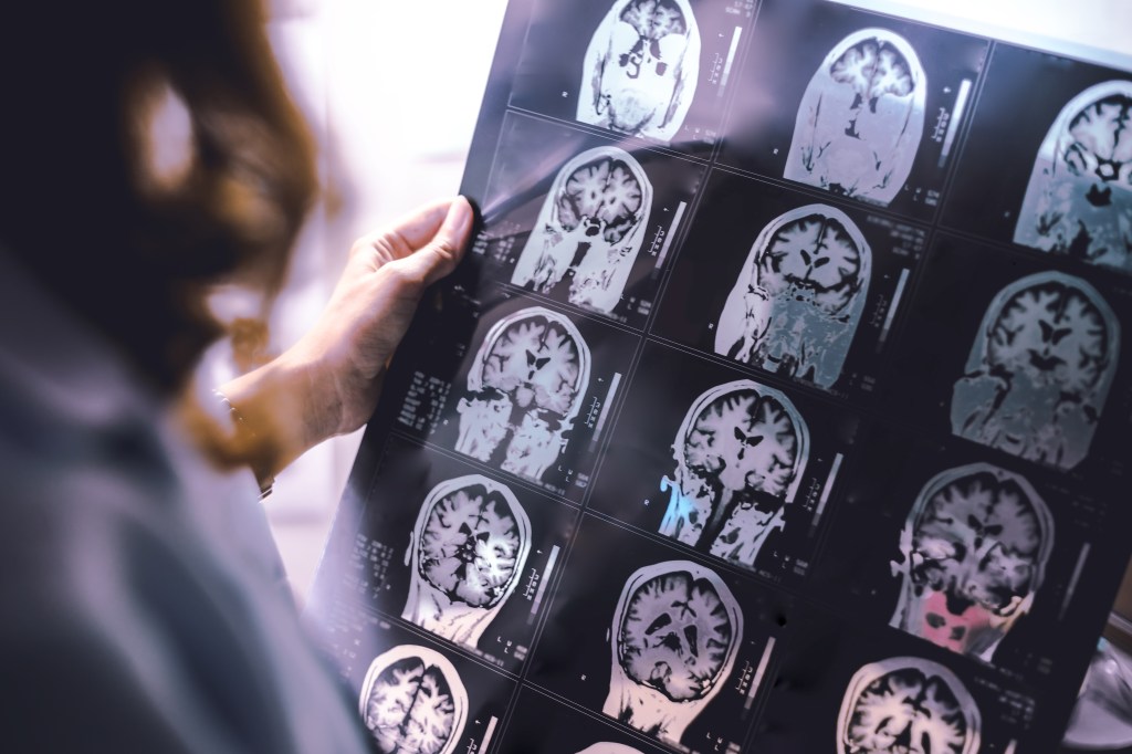 Close-up of a physician holding up MRI scans showing brain atrophy.