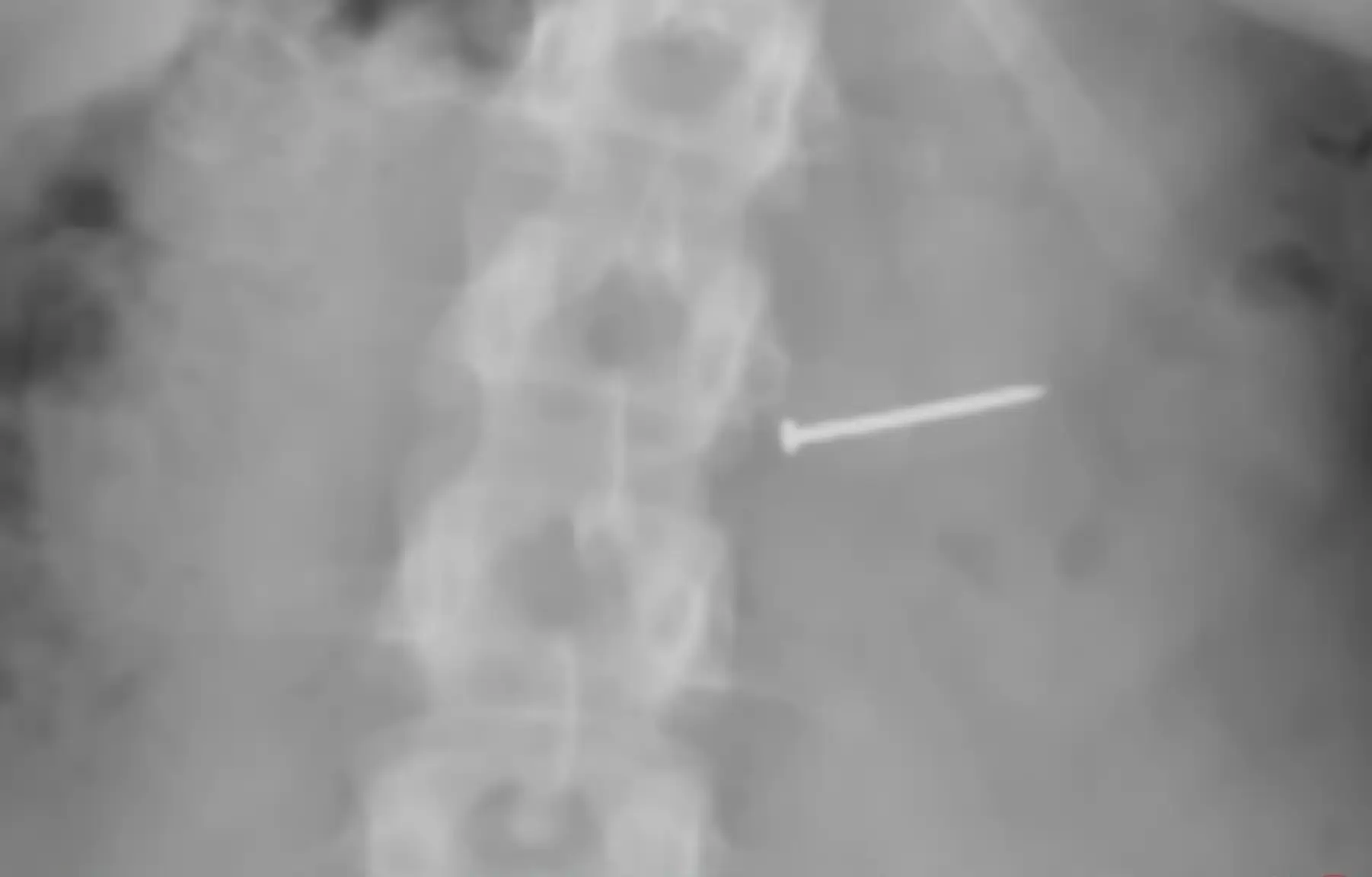 An X-ray confirmed her fears (WESH-TV)