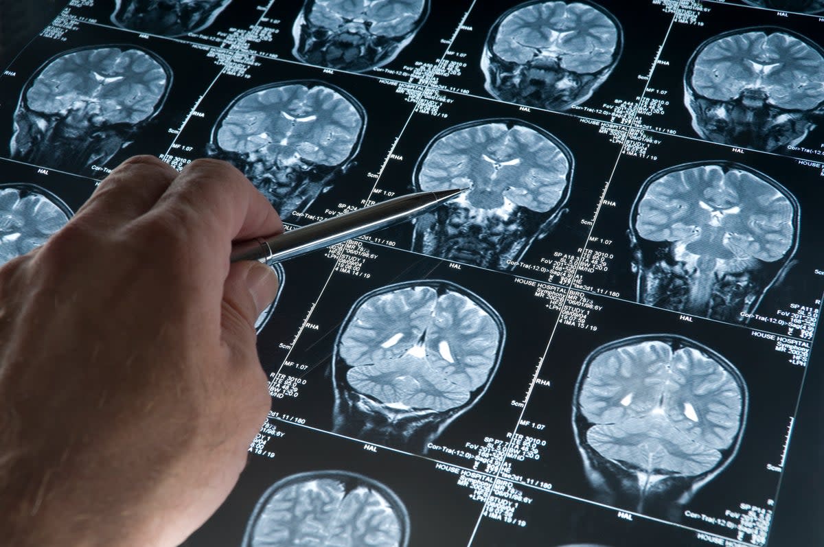 The study included participants having at least two brain MRI scans (Getty/iStock)