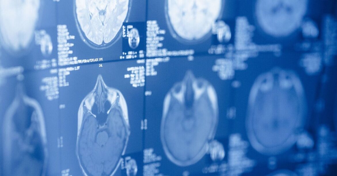 Michael Mosley's much-loved diet that could ward off dementia